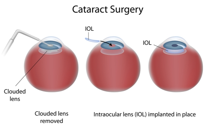 Illustration of cataract surgery with 3 eyeballs. Left one showing clouded lens being removed, middle showing the Intraocular lens implanted being inserted, and right one showing a healed eye with the lens in place.