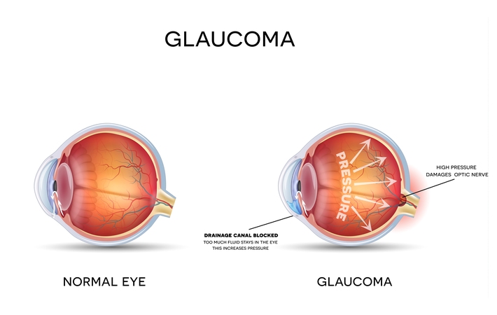 An illustration of what a normal eye looks like versus an eye that has glaucoma
