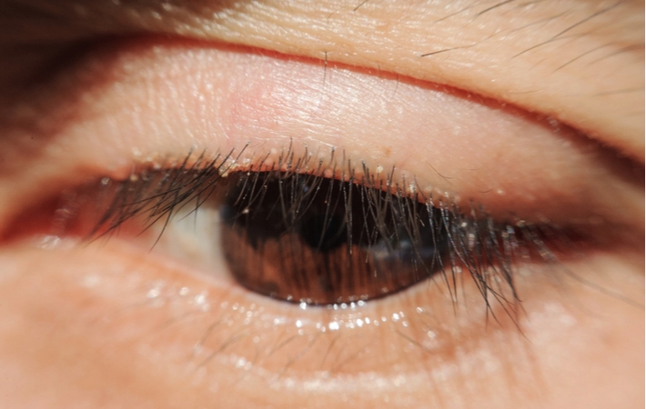 A close up of a swollen eyelid due to the effects of an inflamed meibomian gland