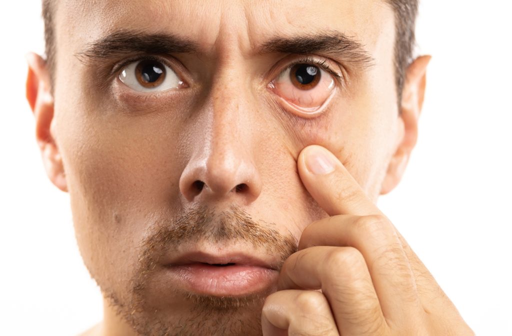 A man with a dry, irritated eye pulling down his lower eye lid