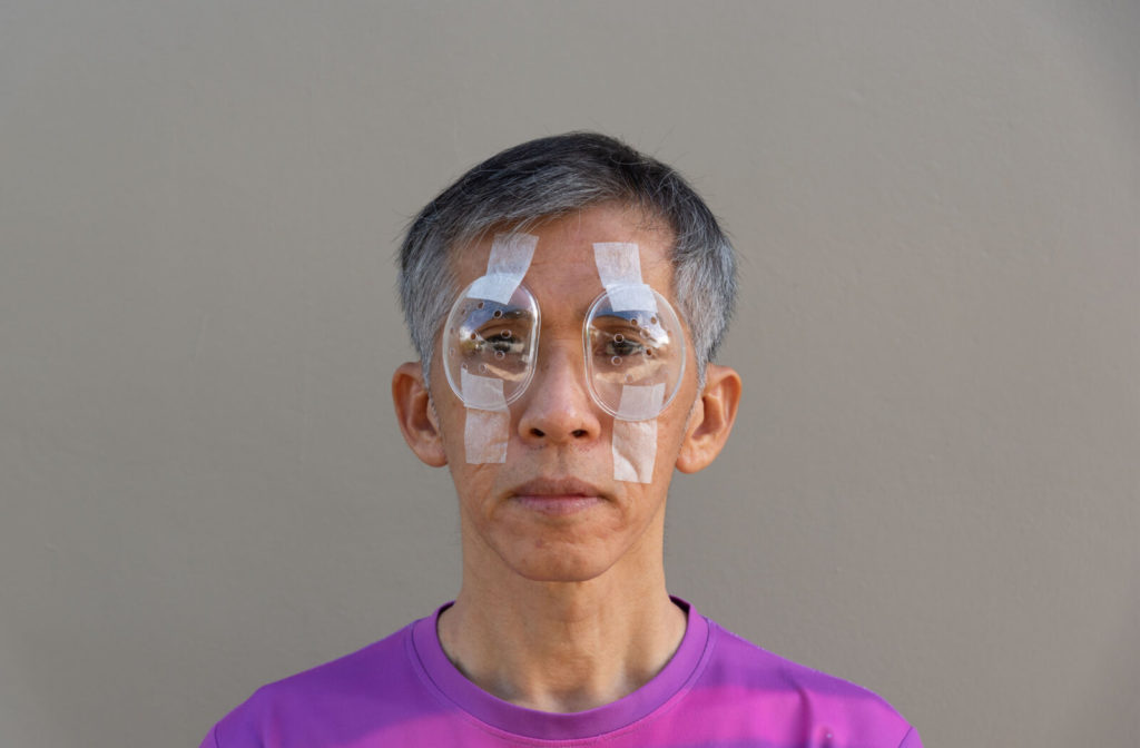 A male senior with both eyes covered with plastic clear protective shields after ICL surgery. Recovery time is typically quicker because there isn’t any tissue removal.
