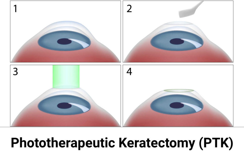 An illustration of how phototherapeutic keratectomy works in treating corneal abrasion.