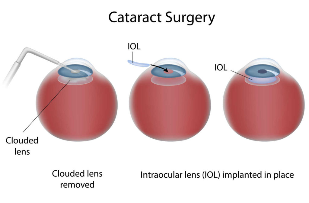 An illustration of how cataract surgery works and how IOLs are implanted in the eye.