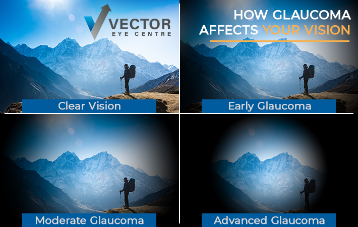 Infographic showing how different types of glaucoma affect vision.