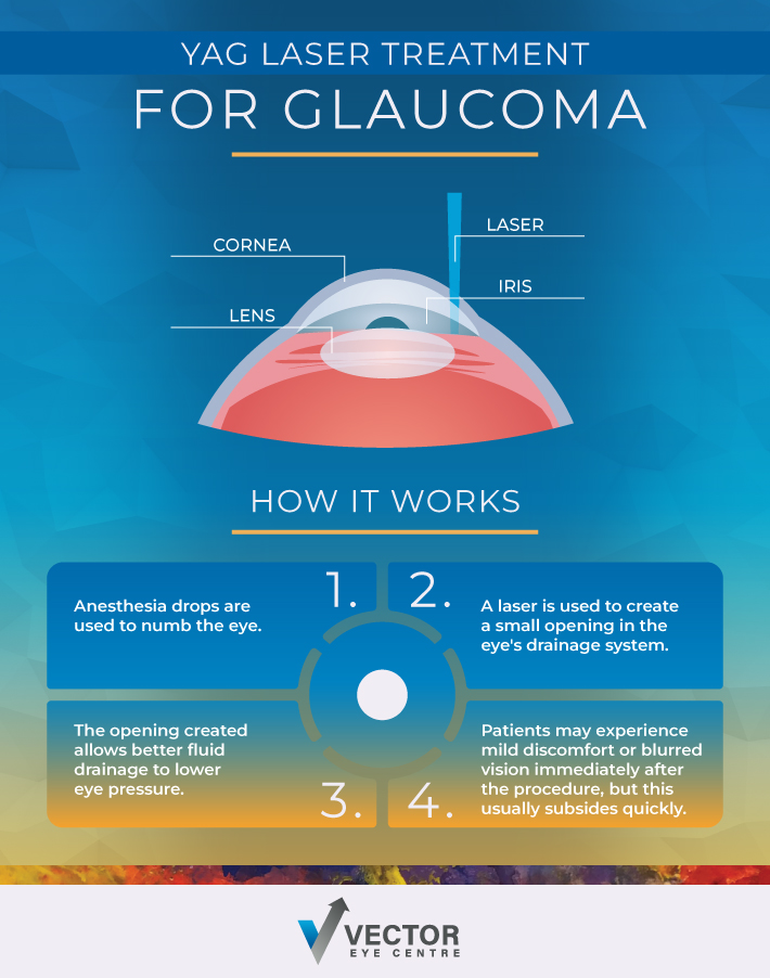 An infographic showing how yag laser treatment works for glaucoma.