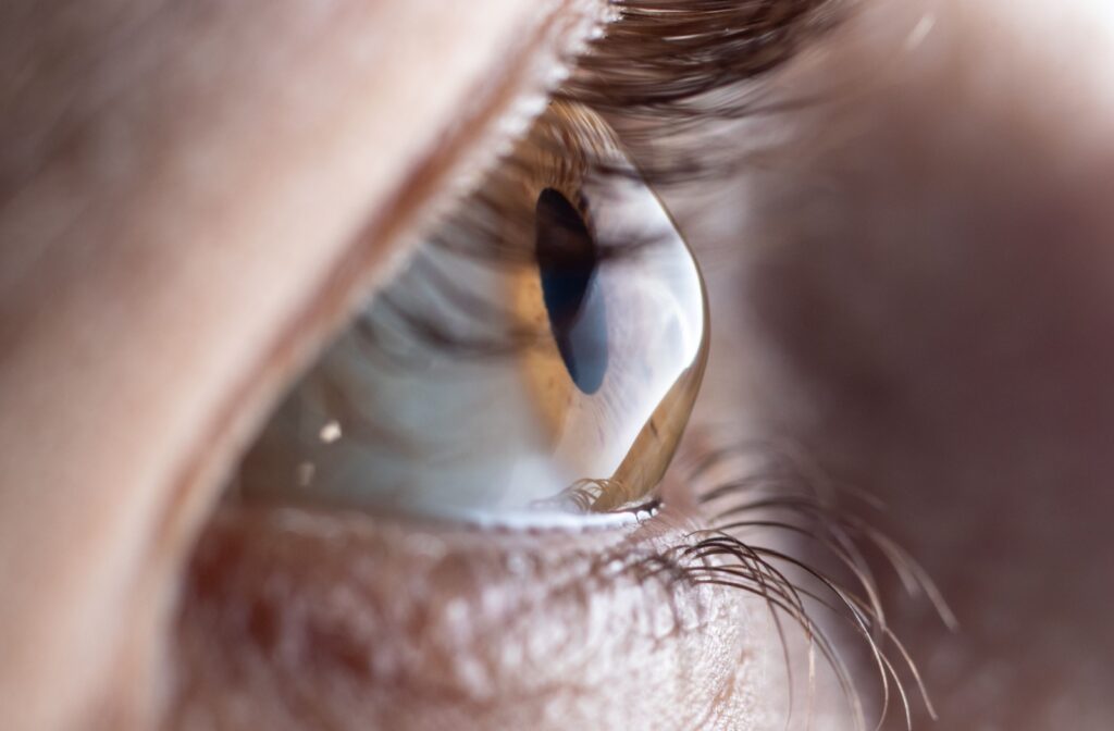 A close-up of a person's eye. Their cornea, the surface of their eye, is bulging out in a cone shape because of keratoconus.