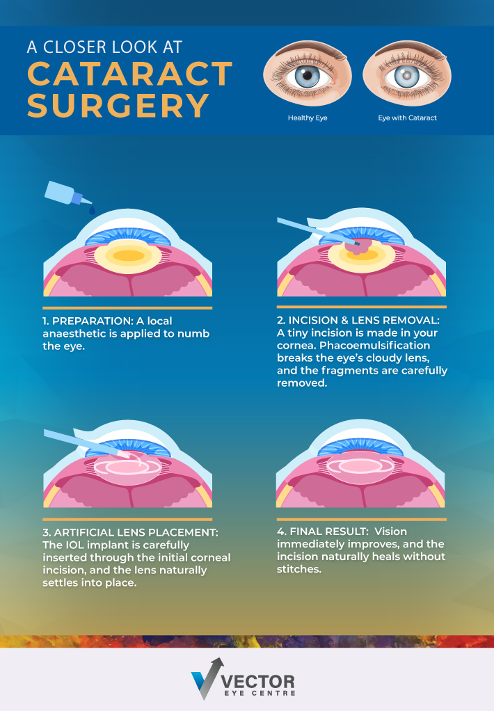 An infographic showing how a cataract surgery is conducted.