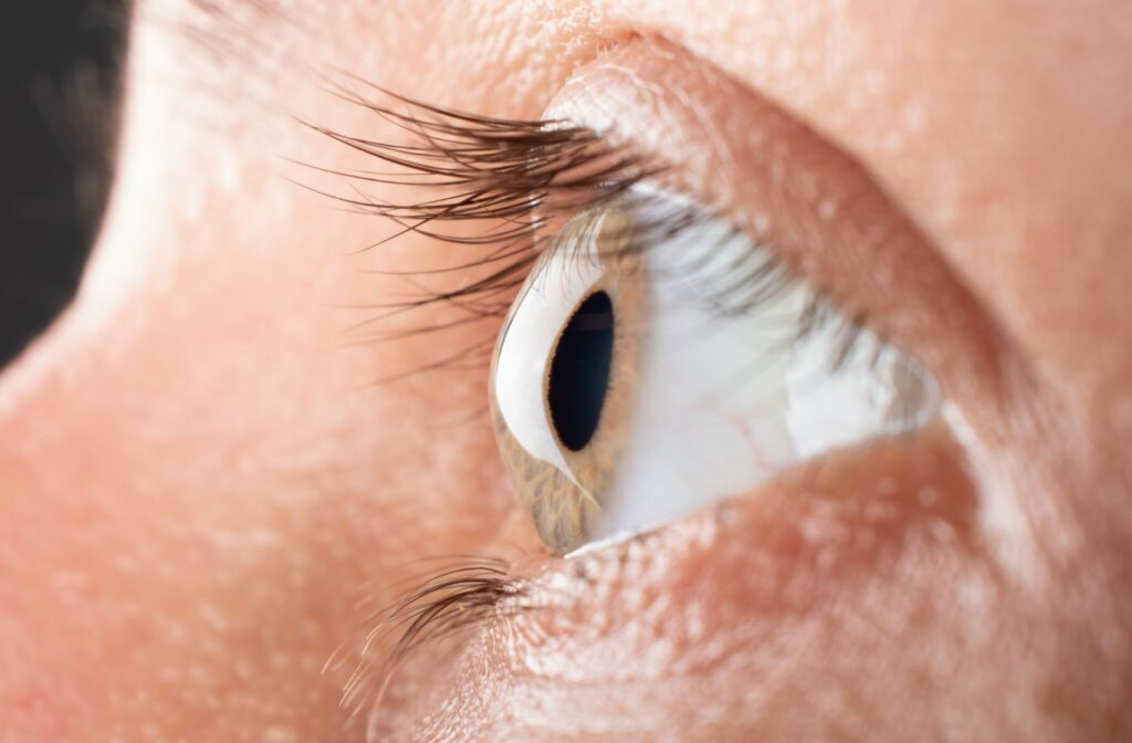A close-up image of an eye that's affected by keratoconus.