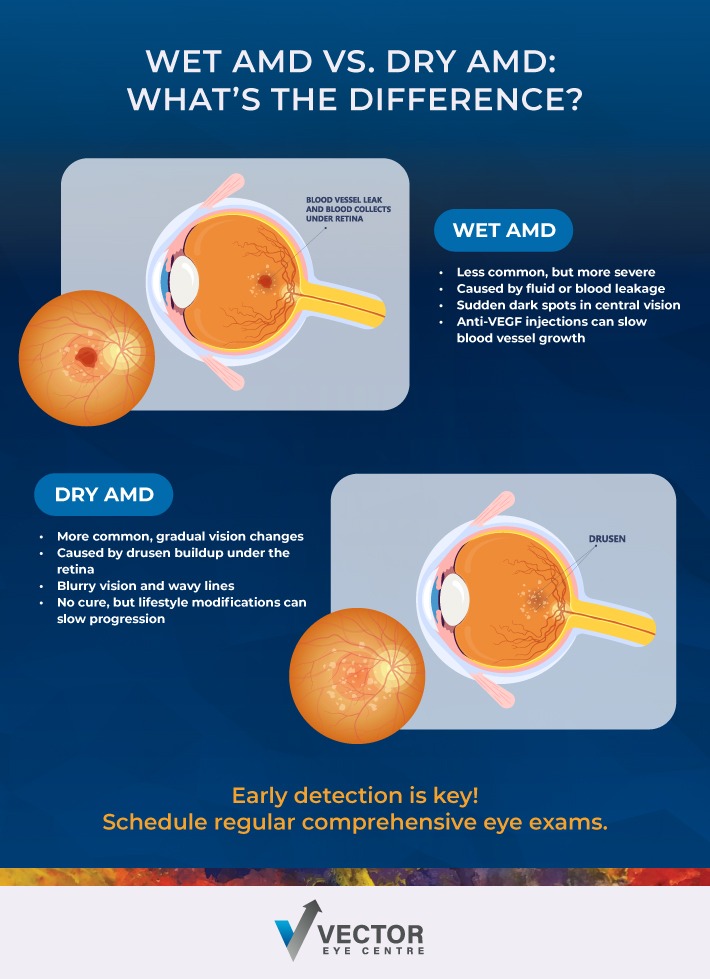 Infographic comparing the differences between Wet AMD vs Dry AMD